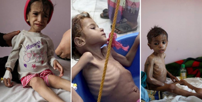 اليونيسف: 2.4 مليون طفل يمني مهددون بالمجاعة
